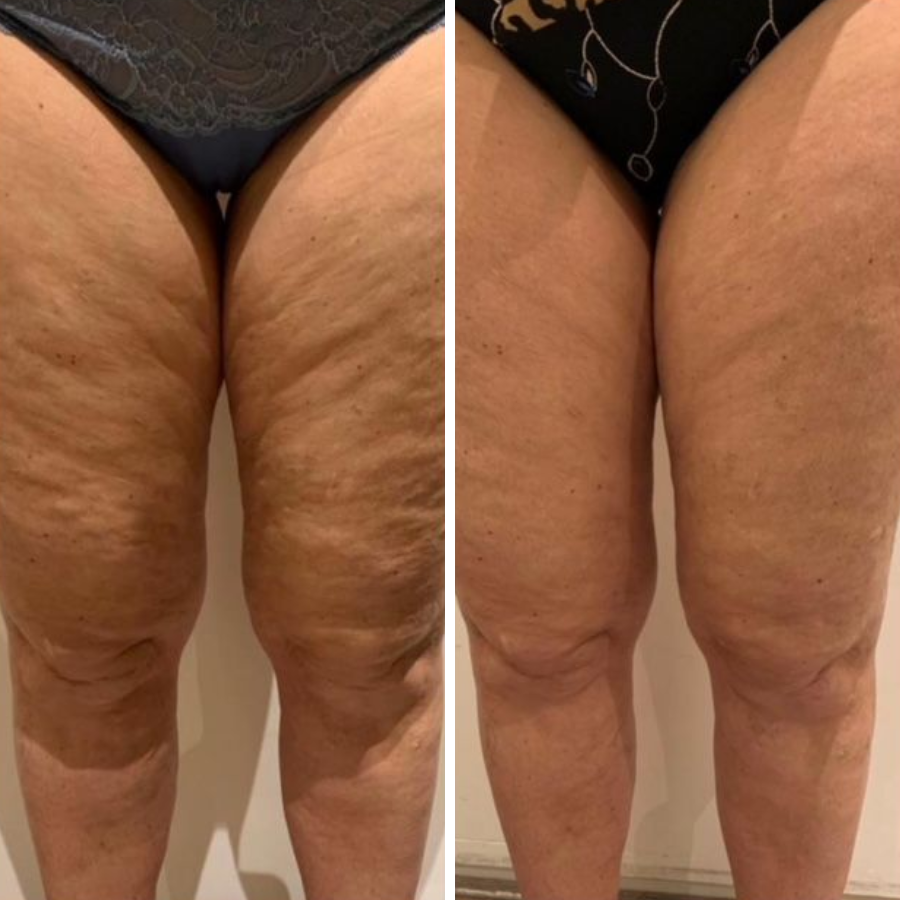 Negusy™ PDRN-GLP-1 Microneedle Slimming & Sculpting Gel