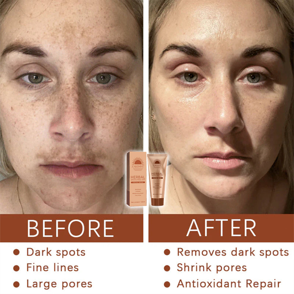 Zakdavi™ Whitening and Spot-Removing Face Mask Suitable for face and body – Natural ingredients permanently remove age spots, freckles, sun spots, and liver spots.