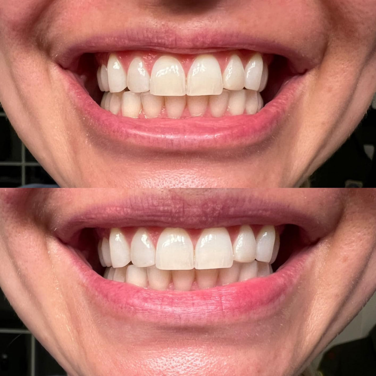 TeethRestoration Mineral Whitening & Repair Powder 🦷 (ADA Recommended)