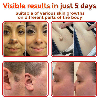Negusy™ MicroNeedle Botanic Skin Tag Removal Patches – 🇺🇸 Made in the USA | Fast, Painless, Plant-Powered