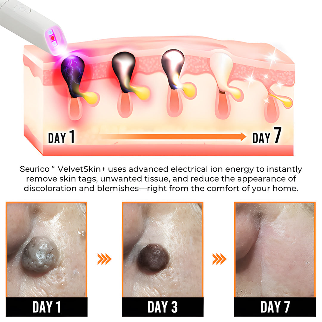 Seurico™ VelvetSkin+ Laser Eraser Pen | Non-Invasive Removal for Moles & Warts