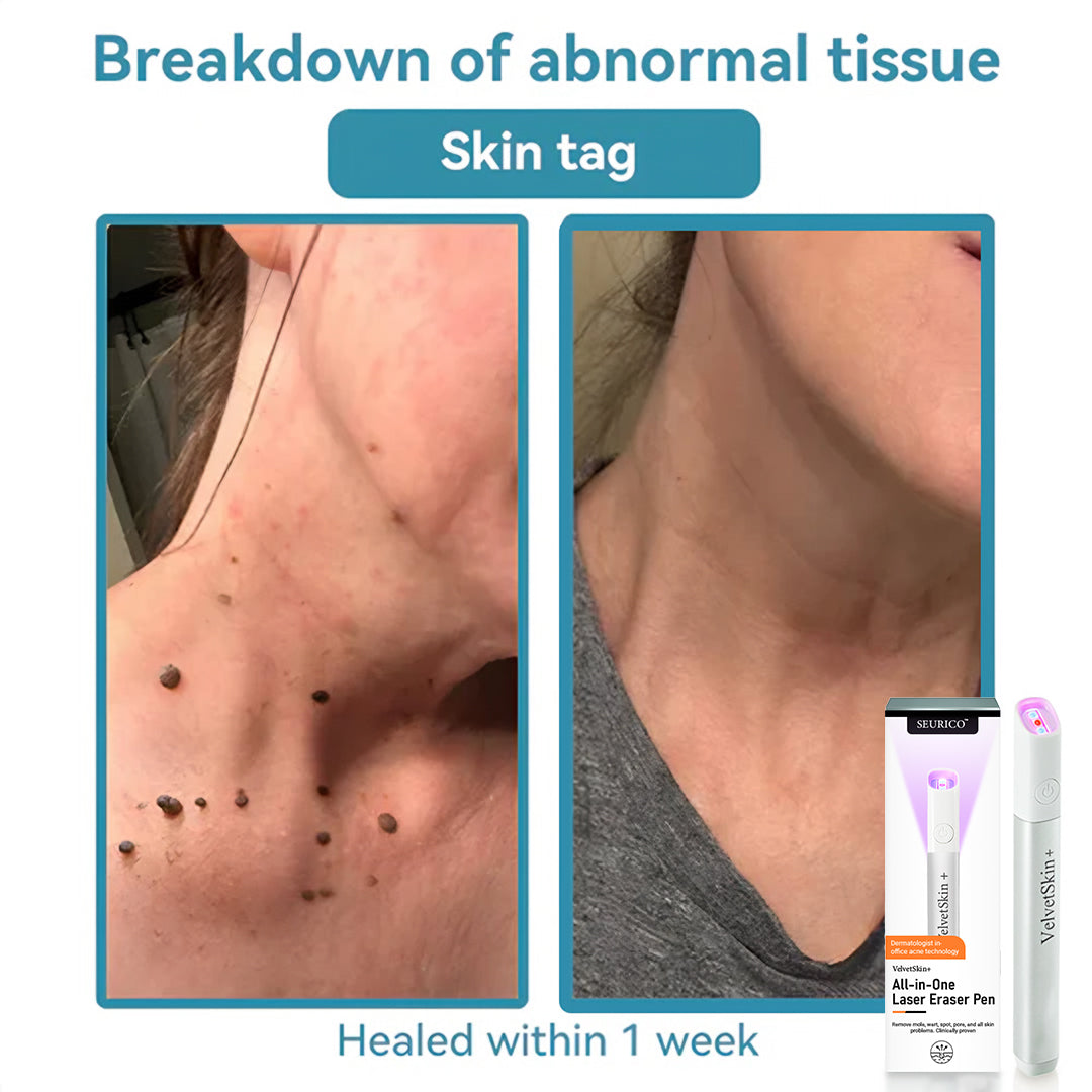Seurico™ VelvetSkin+ All-in-One Laser Eraser Pen✨ | Safe & Easy At-Home Solution for Smooth, Spot-Free Skin 💆‍♀️🌟