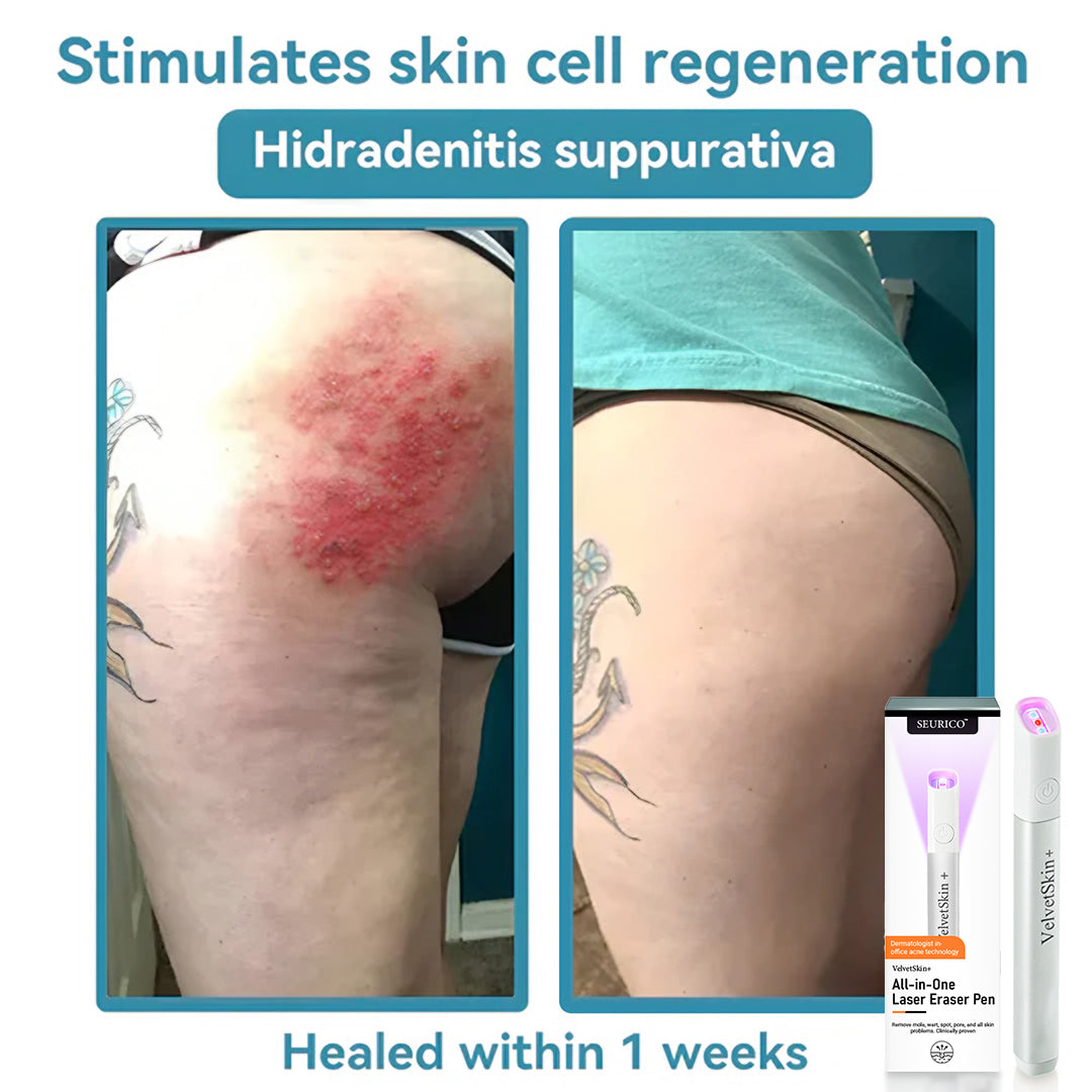 Seurico™ VelvetSkin+ Laser Eraser Pen | Non-Invasive Removal for Moles & Warts