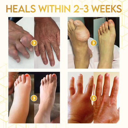 🎁Flash Sale - ODALIT™ Botulinum Toxin & Bee Venom Pain-Relief Bone Healing Cream