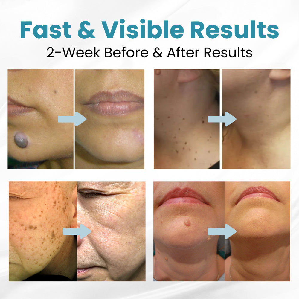 ✨Seurico™ Laser Pen - Non-invasive Mole and Wart Removal.