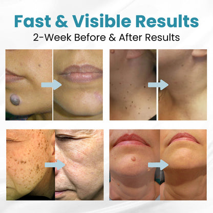 ✨Seurico™ Laser Pen - Non-invasive Mole and Wart Removal.
