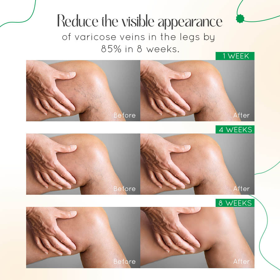 ODALIT™ Vein Therapy Cream – Natural Relief for Varicose & Spider Veins 🌿✨