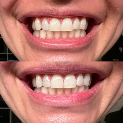 TeethRestoration Mineral Whitening & Repair Powder 🦷 (ADA Recommended)